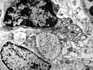 Whipple disease - lipid malabsorption Whipple disease - lipid malabsorption